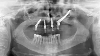 健康・医学 216 IMPLANTS Ultimate guide The continued evolution of dental implant surgical guides